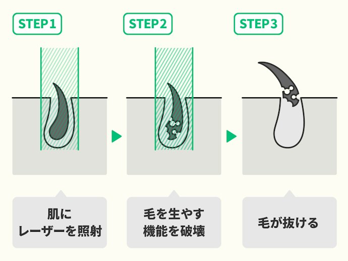 医療レーザー脱毛とは?仕組みや効果は?