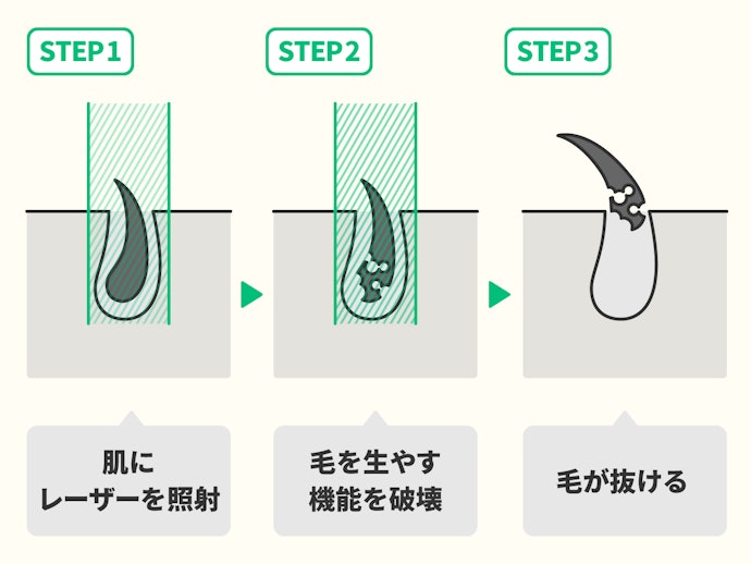 ヒゲ脱毛の効果は?永久脱毛してもヒゲは生えてくる?