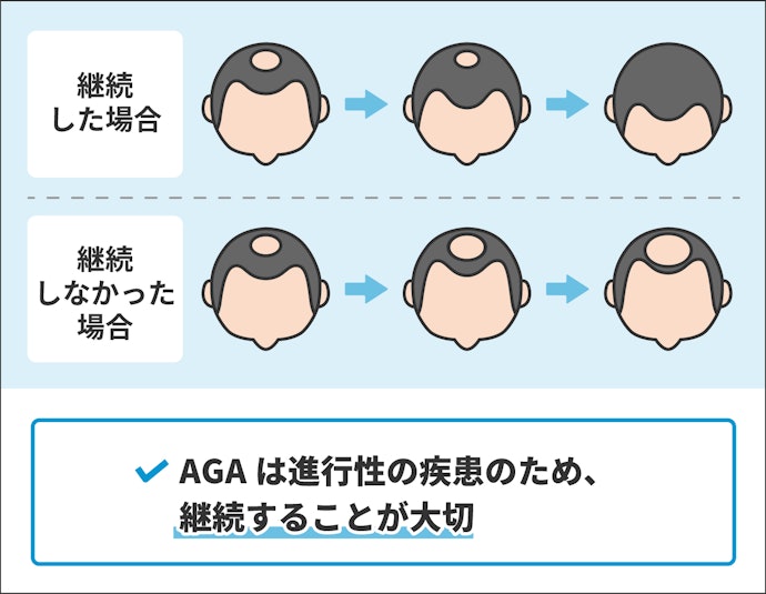FAGA治療は効果が出たらやめてもいいの?