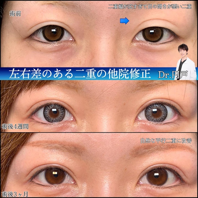 二重整形で起こりやすい失敗は?対策方法はある?