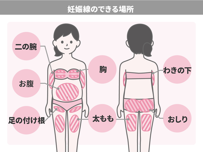 妊娠線はお腹以外の場所にもできるの?