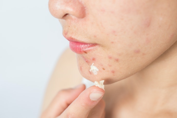 ニキビ用塗り薬を使用するときの注意点は?