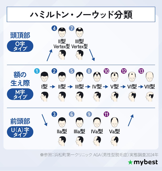 AGAの進行度はどう測る?自分の進行度を知るには?