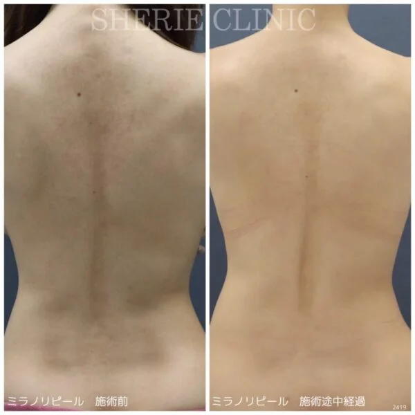 背中がシミだらけ?シミの種類によって必要な施術は異なる