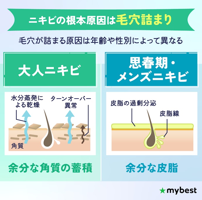ニキビの原因は?