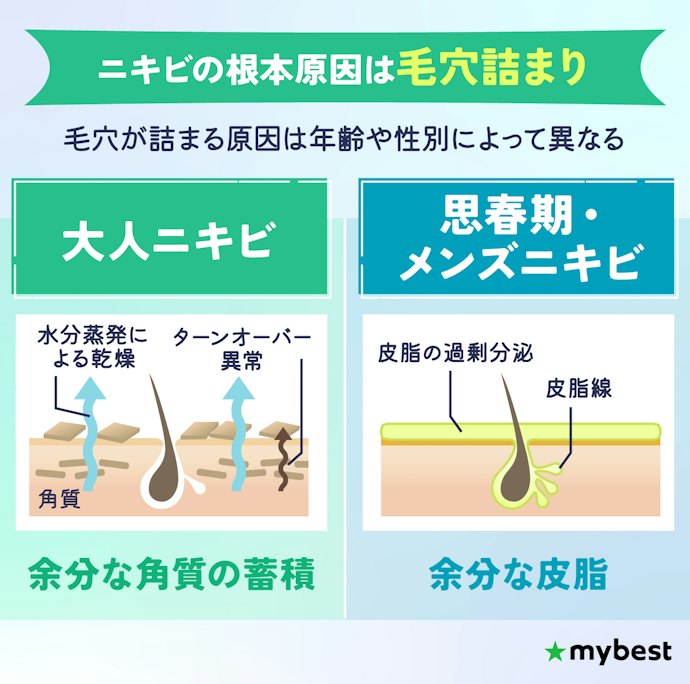 ニキビの原因は?