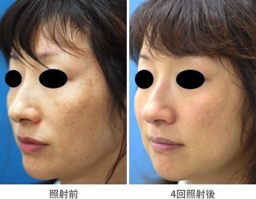 肝斑治療は内服薬とレーザーのどちらがいい?