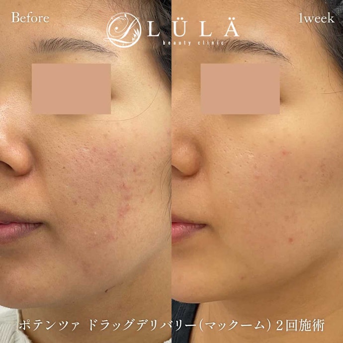 ポテンツァとは?値段はどのくらい?