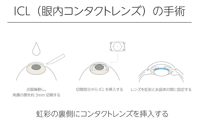 ICL手術とは?レーシックとの違いは?