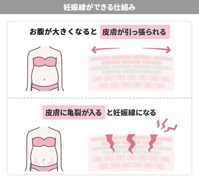 妊娠線ができる仕組みとは?どうやって予防するの?