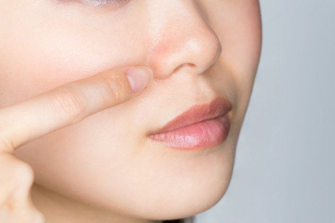 いちご鼻の治し方は?おすすめの治療法は?