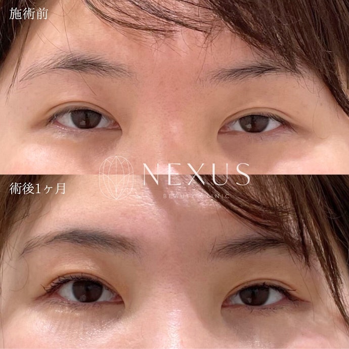 目元ハイフのダウンタイムや副作用は?