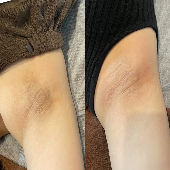 脇の黒ずみの原因は?スクラブやクレンジングで改善する?
