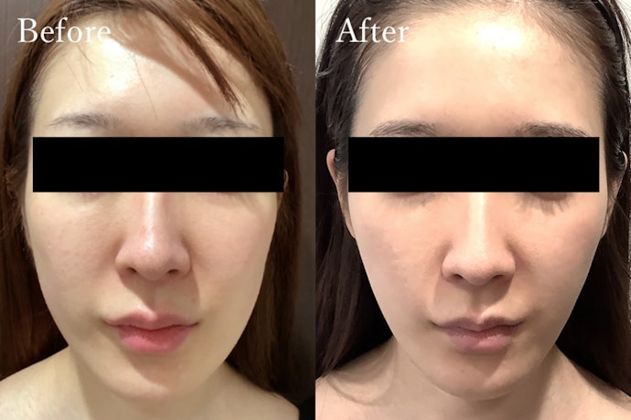 ハイフにはどんな効果があるの?即効性や持続性はある?