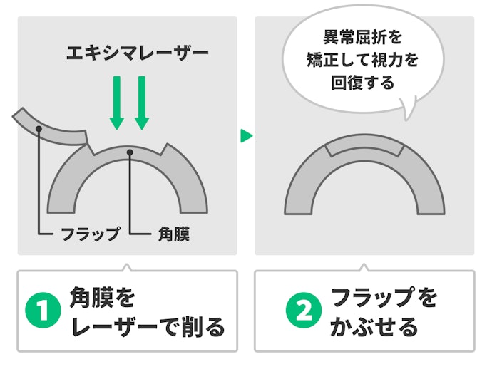 レーシックとは?