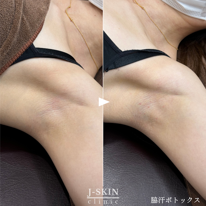 脇ボトックスの効果は?保険適用される?