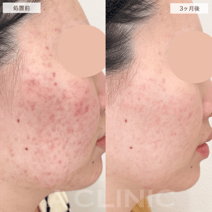 ポテンツァのダウンタイムはどれくらい長い?症状は?