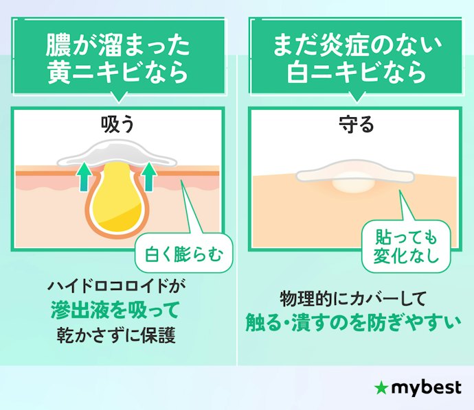 白ニキビや、膿がたまった黄ニキビに。どんなニキビに使える?