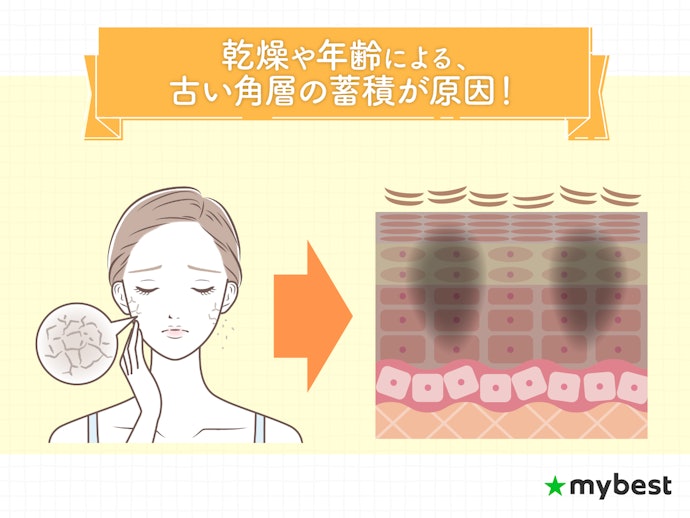 肌のごわつきやくすみの原因は?