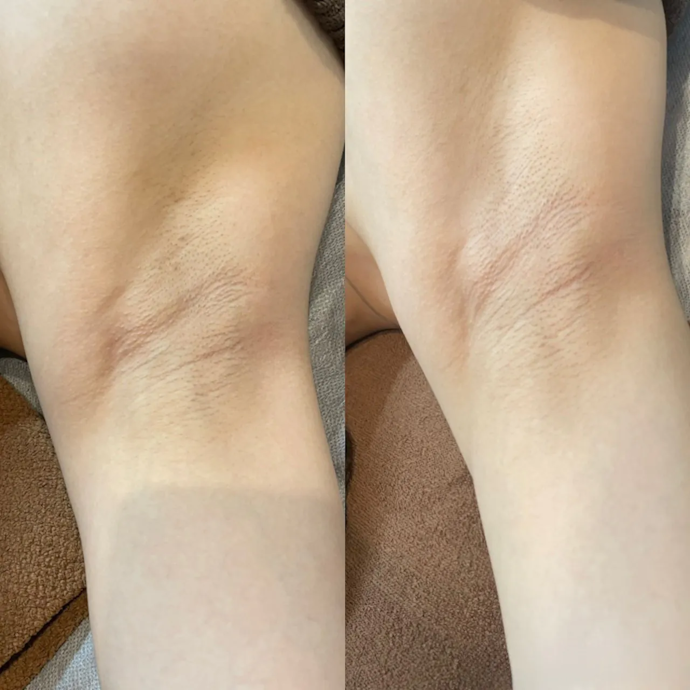 脇の黒ずみはどれくらいで治る?