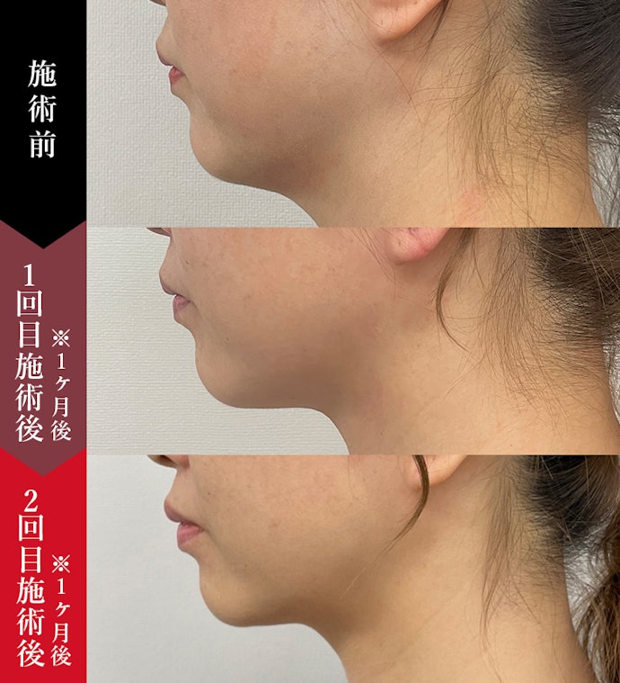 脂肪溶解注射とは?脂肪吸引との違いは?