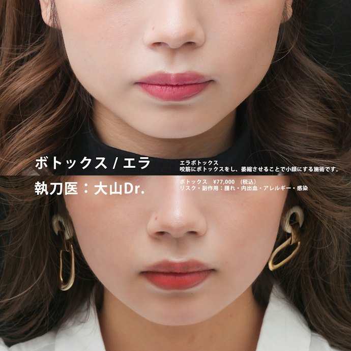 エラボトックス(エラボト)のダウンタイムの期間や副作用は?効果はどれくらい持つの?