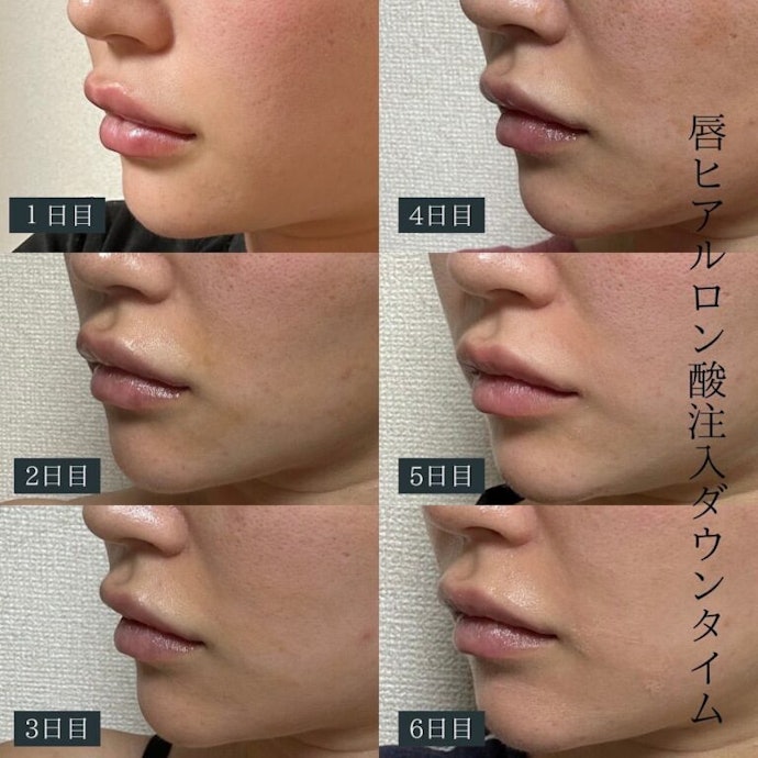唇のヒアルロン酸は痛い?ダウンタイムやリスクは?