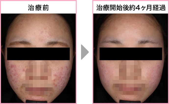 美容内服は効果ない?効果はいつから出るの?