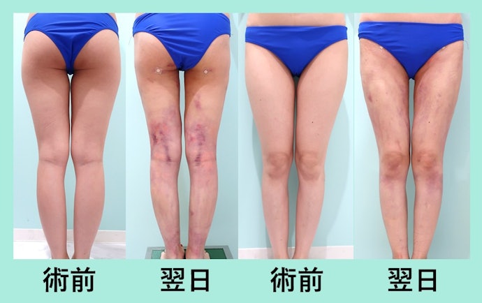脂肪吸引のダウンタイムの期間はどのくらい?施術後の注意点も紹介