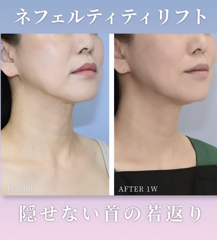 スキンボトックスのデメリットやダウンタイムは?痛い?