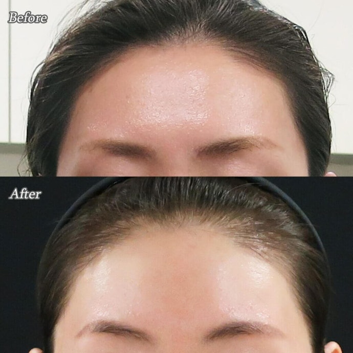 おでこ・額ボトックスで目が開きにくくなる(眼瞼下垂)って本当?