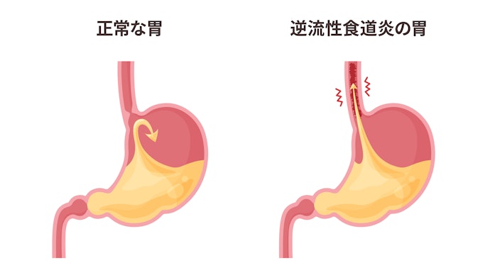 逆流性食道炎とは?市販薬で治るの?