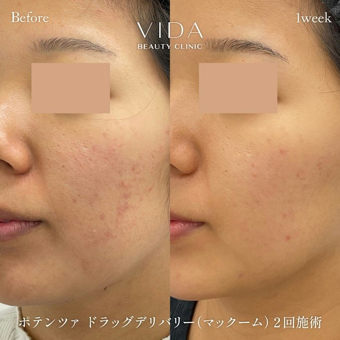 ポテンツァとは?値段はどのくらい?