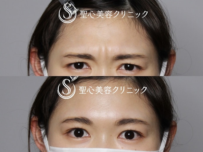 眉間ボトックスのダウンタイムや副作用は?
