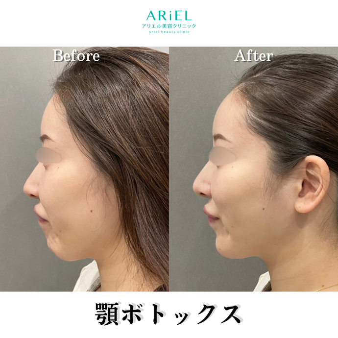 顎ボトックスのダウンタイムは?笑顔が不自然になるって本当?