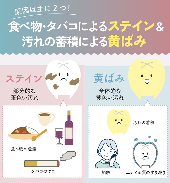 気になる歯の着色の原因とは?
