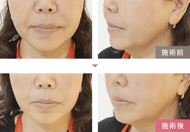 ハイフの効果とは?持続性や即効性はあるの?