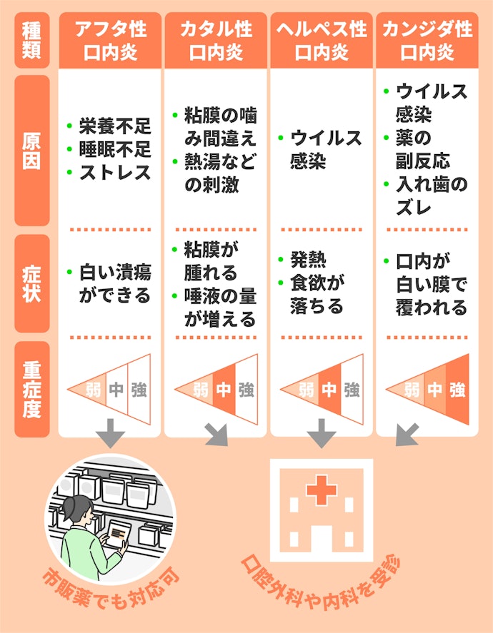 病院での治療が必要な場合も。市販薬で対応できるのは「アフタ性口内炎」のみ