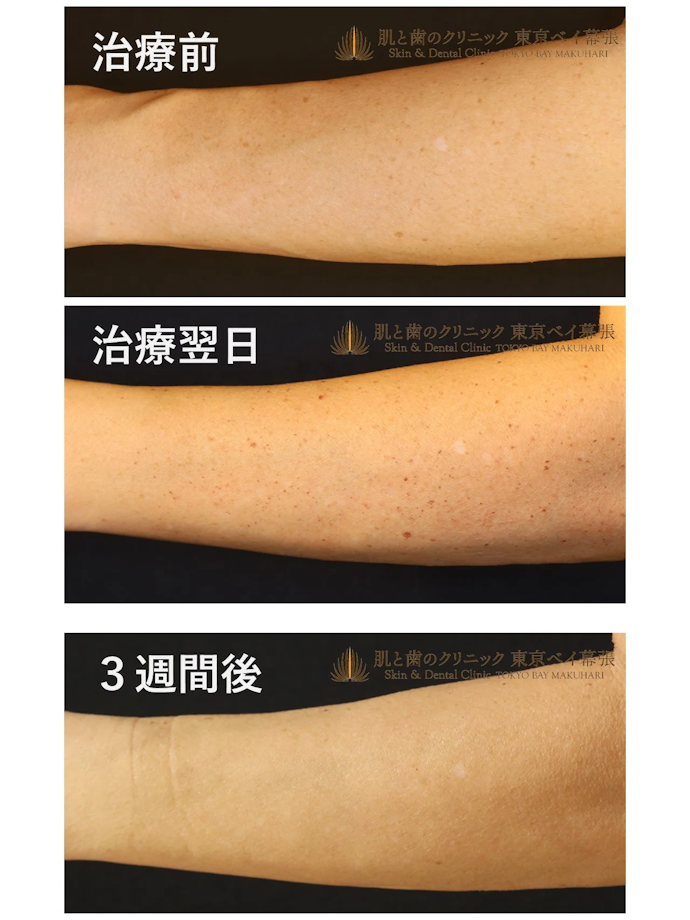 腕のシミ取りのダウンタイム・デメリットは?