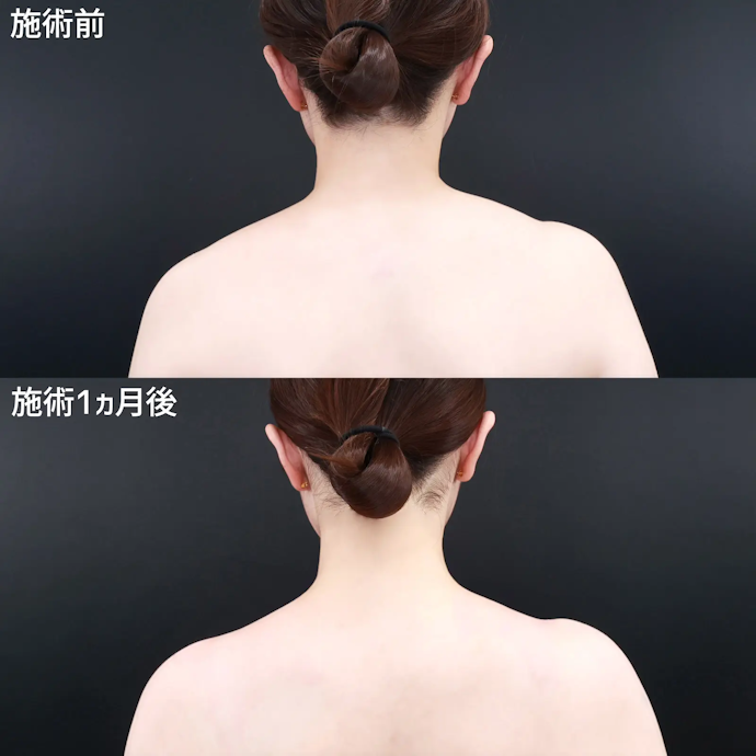 肩ボトックスとは?効果は?
