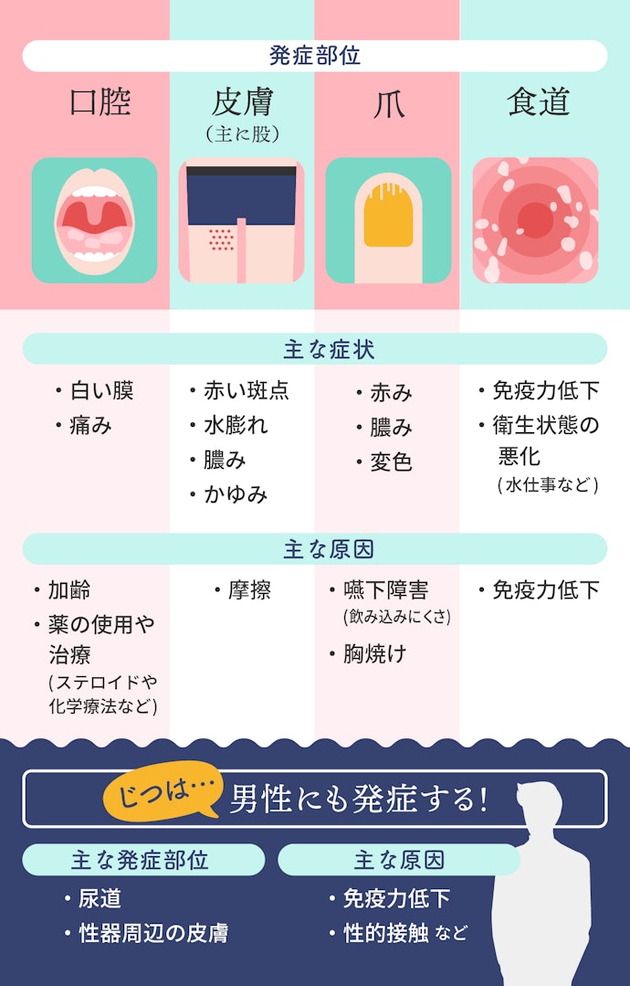 カンジダは膣以外にも発生する!?男性も発症することがあるって本当?