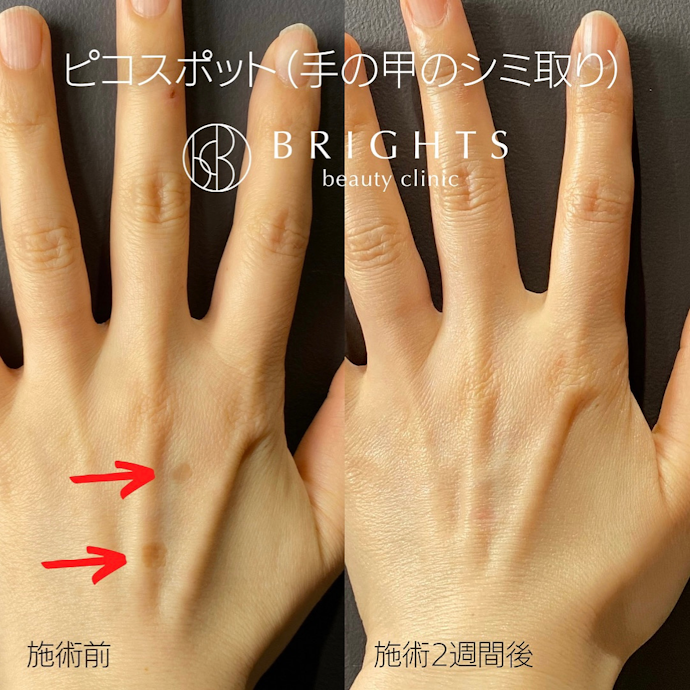 手の甲のシミ取りのダウンタイム・デメリットは?