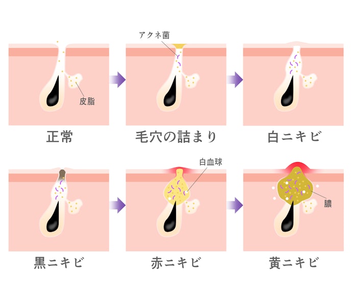進行度によるにニキビの種類を知ろう