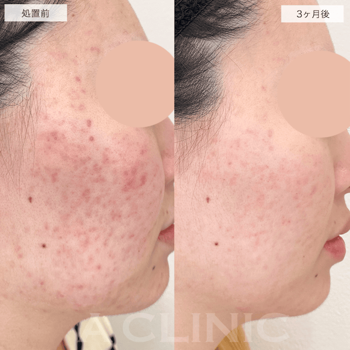 ポテンツァのダウンタイムはどのくらい?よくある症状は?