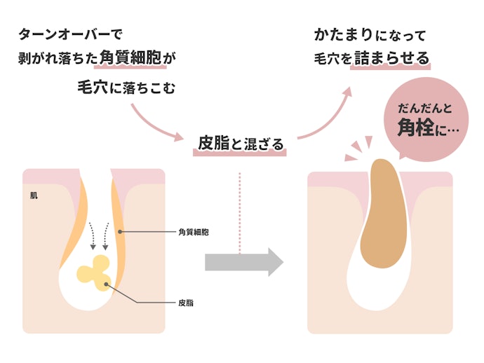 角栓が詰まってしまうのはなぜ?