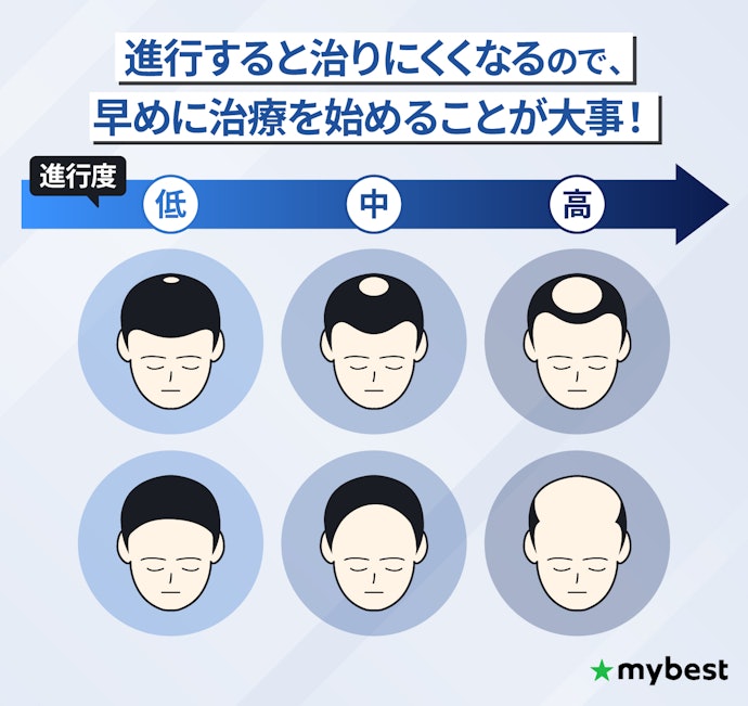 AGA治療は40代・50代から始めても効果ある?30代でも発症する?