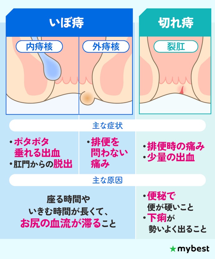 いぼ痔・切れ痔とは?女性と男性で原因・症状は違う?