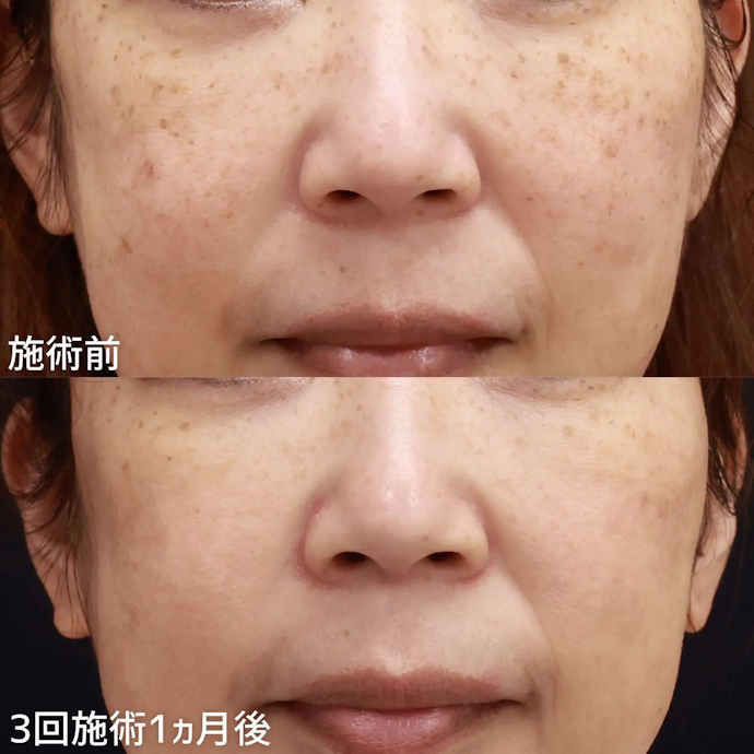 フォトシルクプラスは毛穴に効果がある?