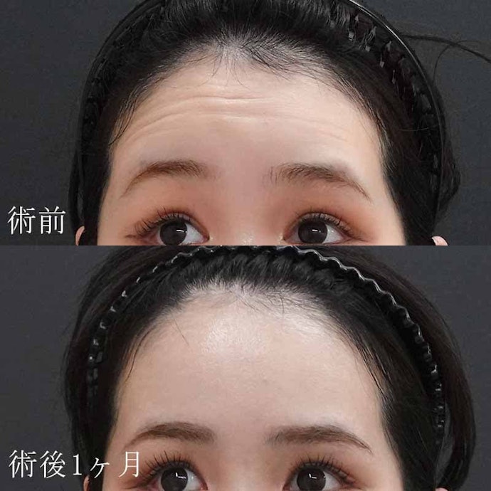 おでこ・額ボトックスのリスクやダウンタイムは?