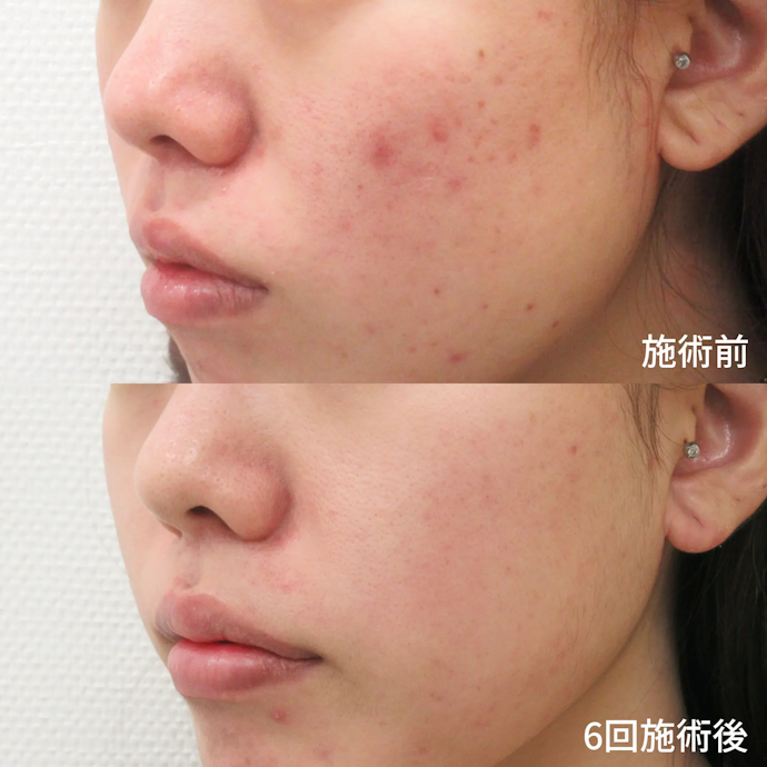 フォトシルクプラスとは?薄いシミや肝斑に効果はある?